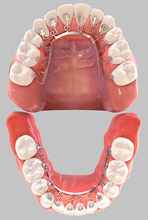 The BRIUS system installed on a model of teeth with an open jaw taken from above.